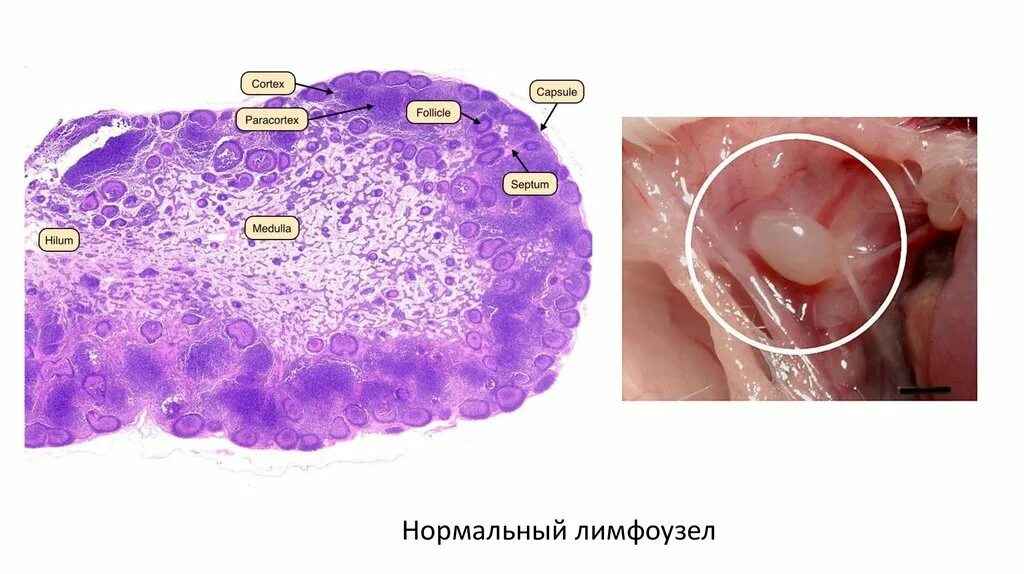 Кератоакантома что это такое фото Морфология неопухолевых лимфаденопатий - презентация онлайн