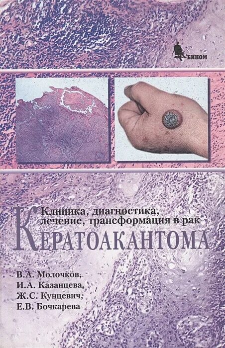 Кератоакантома что это такое фото Кератоакантома. Клиника, диагностика, лечение, трансформация в рак * Молочков В.