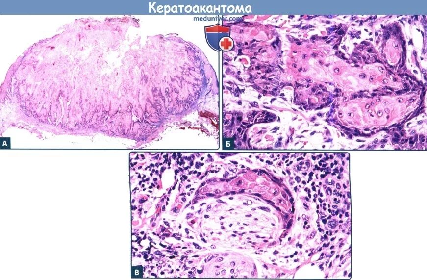 Кератоакантома что это такое фото Цитология и гистология кератоакантомы