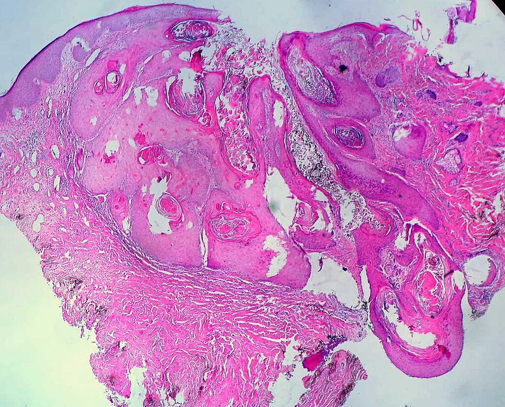 Кератоакантома что это такое фото Keratoacanthoma 43-year-old woman with "right ear mass." I. Flickr