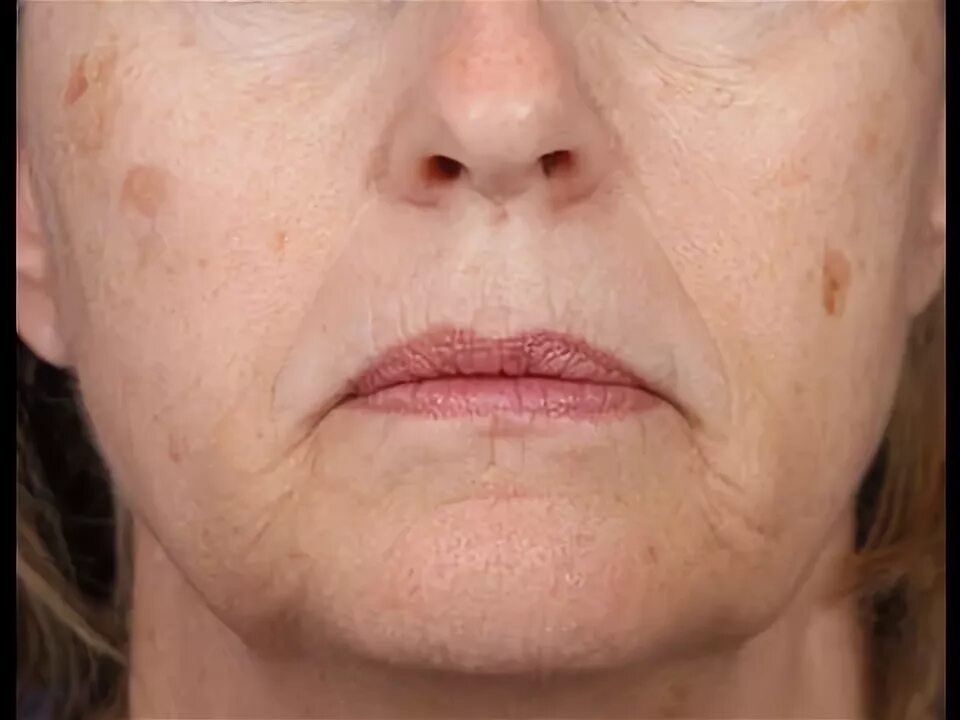 Кератома фото у женщин после 50 лет The Different Types of Brown Spots DermTV.com Epi #474 - YouTube