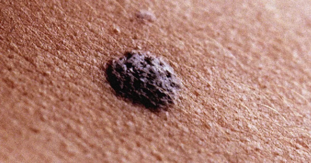 Кератома фото у женщин после 50 лет Rise in mole removals linked to suntans and sunbed cancer - Mirror Online