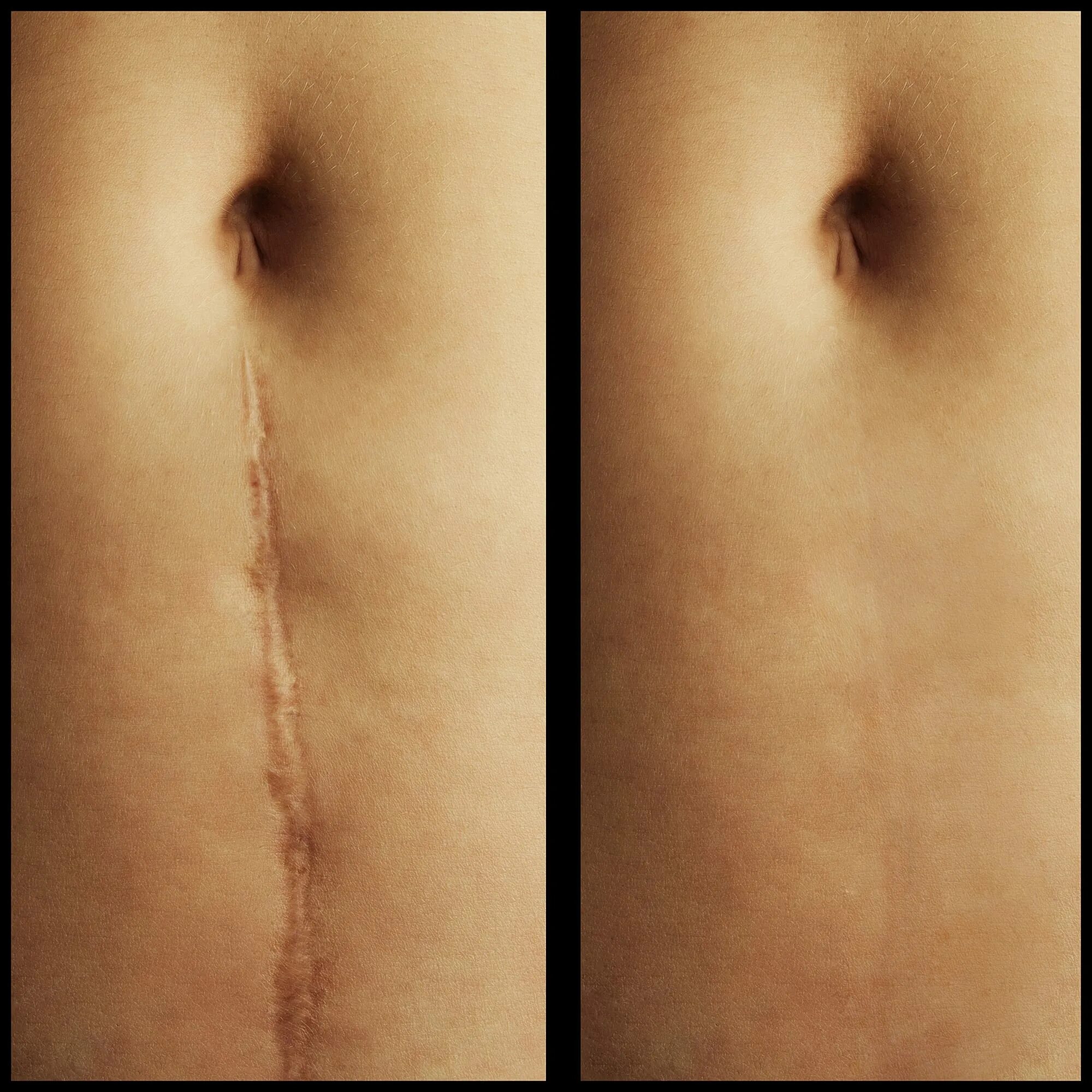 Кесарево фото до и после Académie fusible retour scar camouflage healing process complications exilé je p