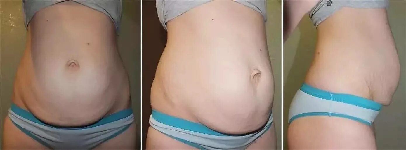 Кесарево фото до и после Фото после кесарева: найдено 30 изображений
