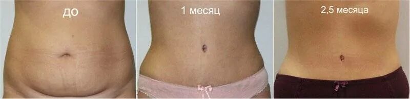 Кесарево фото до и после Чем и как долго обрабатывать шов после кесарева сечения