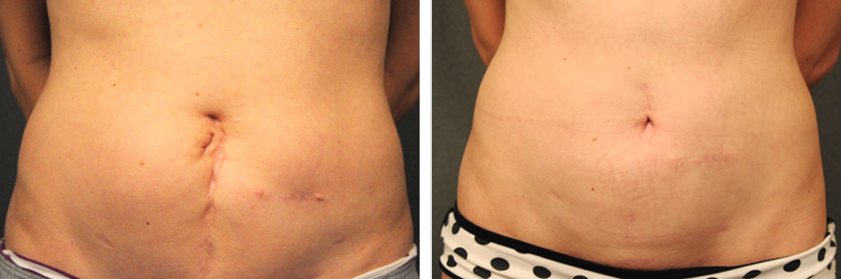 Кесарево фото до и после essay Seem Rank after plastic surgery scars Around Full intelligence