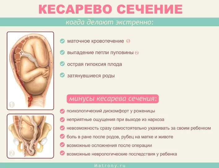 Кесарево фото до и после Картинки СХВАТКИ 38 НЕДЕЛИ