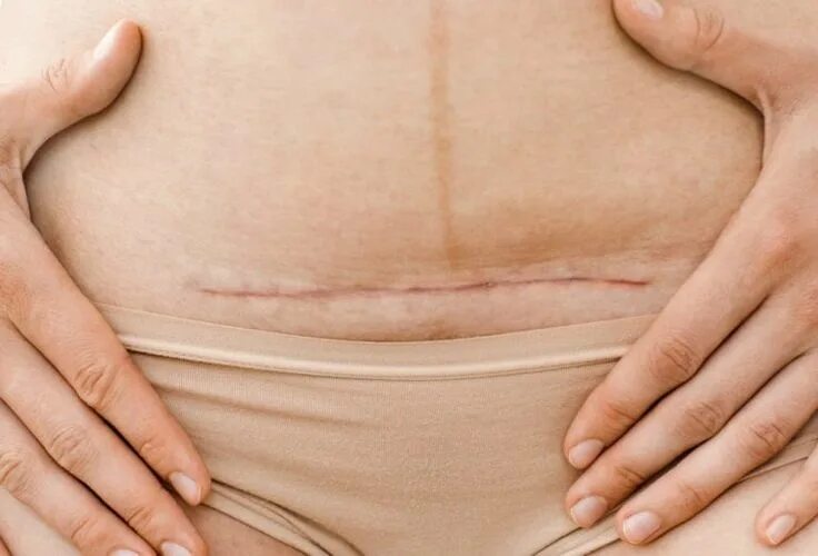 Кесарево сечение фото до и после 7 things you should avoid after having a C-section C section recovery, C section