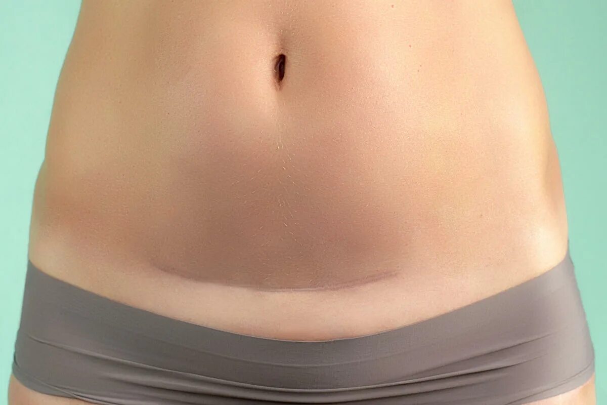 Кесарево сечение фото до и после Sports Illustrated model shows C-section scar in magazine