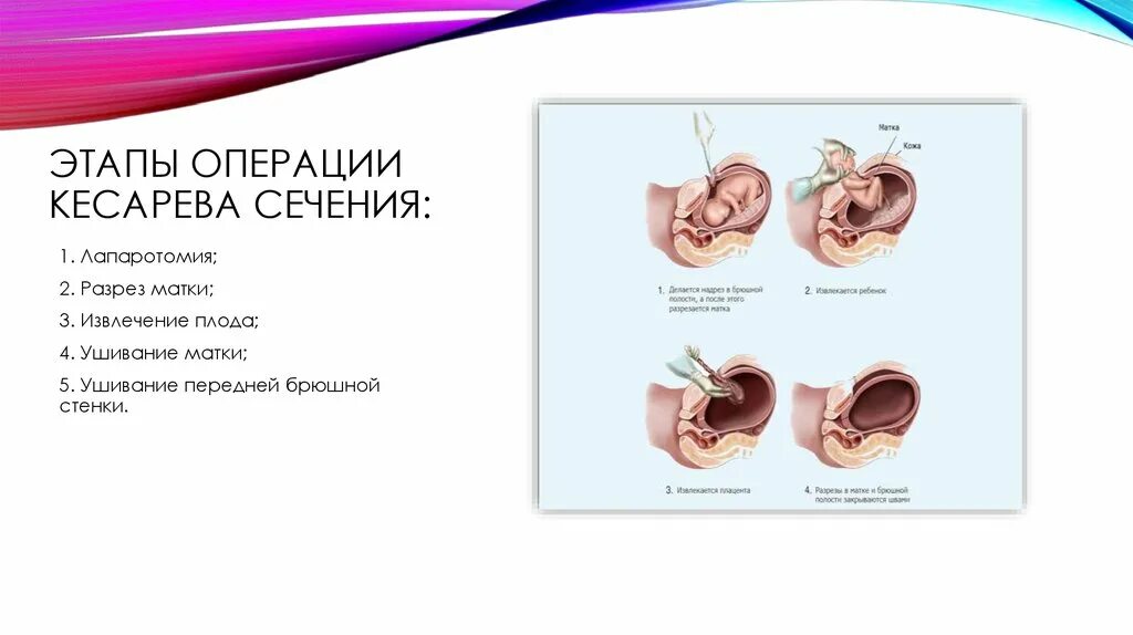 Кесарево сечение фото до и после Мягкое кесарево сечение: Мягкое кесарево сечение - плюсы и минусы - Living Trans