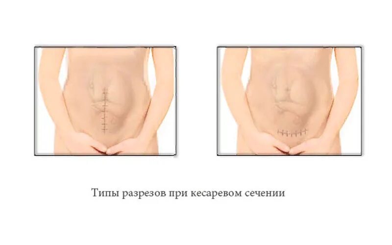 Кесарево сечение фото до и после Вся правда о кесаревом сечении - когда проводят и зачем это нужно? О детском здо