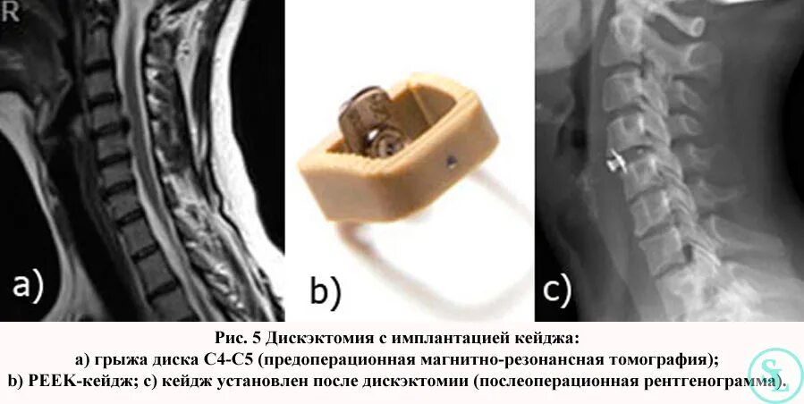 Кейдж для позвоночника шейного отдела фото Стеноз позвоночного канала шейного отдела, лечние, операция, виды