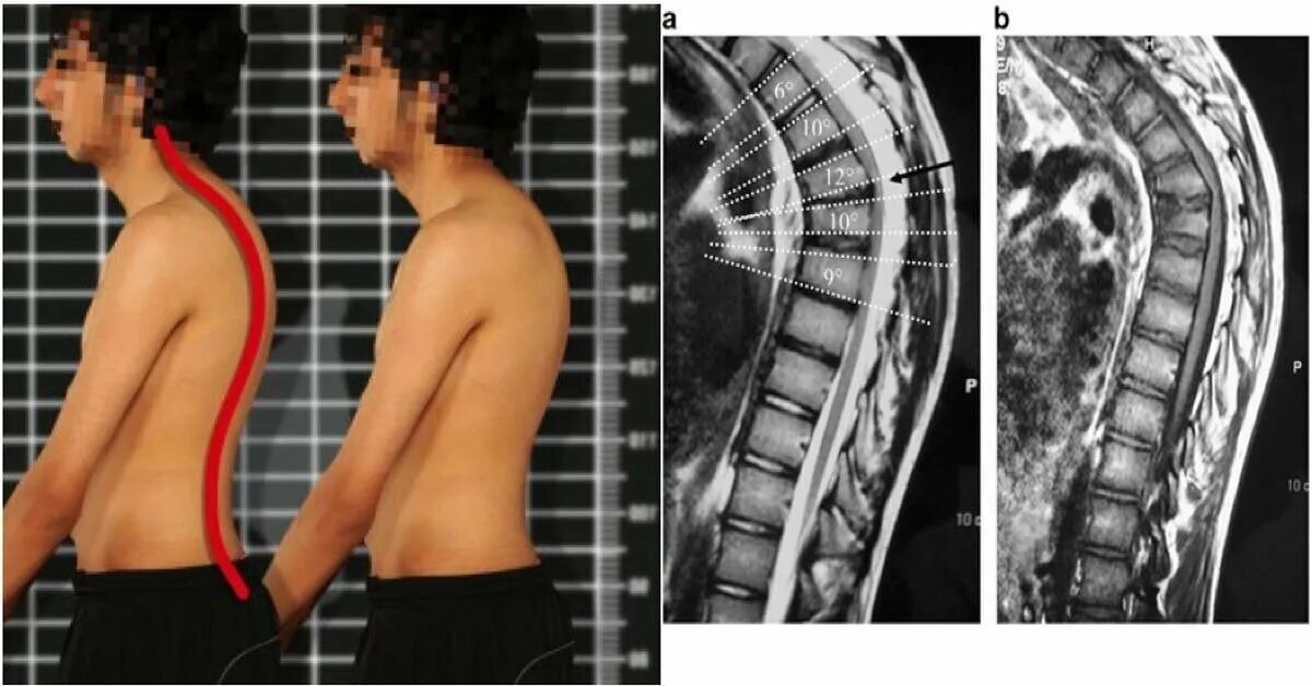 Кифосколиоз грудного отдела позвоночника фото Боль в грудном отделе позвоночника. Часть вторая Доктор Котляр Владислав Альберт