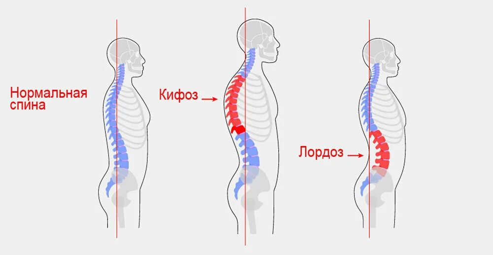 Кифоз поясничного отдела упражнения фото Искривление позвоночника - проблема, знакомая многим. Врачи рассказали, как прав
