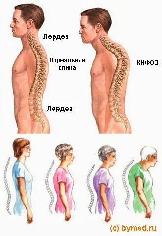 Кифоз поясничного отдела упражнения фото Альтернативная медицина: ноября 2014