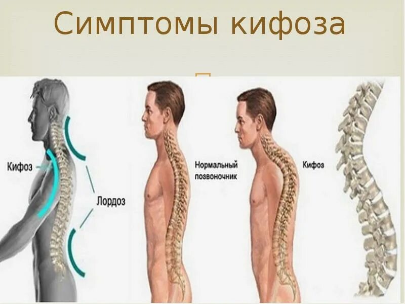 Кифоз поясничного отдела упражнения фото Степени кифоза позвоночника