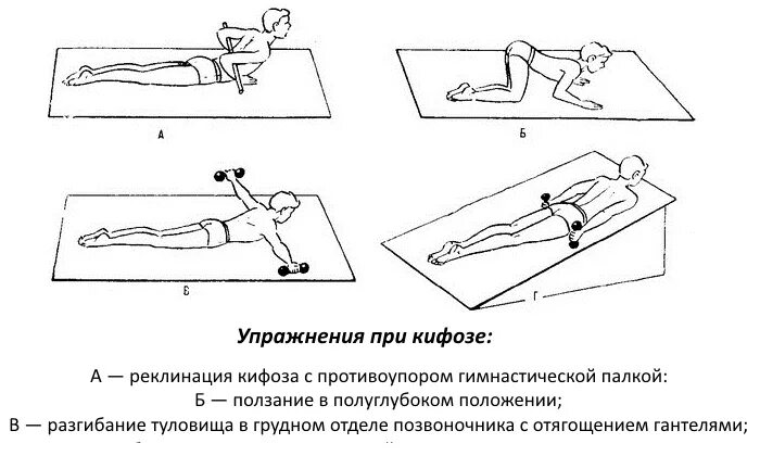 Кифоз поясничного отдела упражнения фото 3 Упражнения (гимнастика) при кифозе - польза и вред комплекса ЛФК spravki1.ru