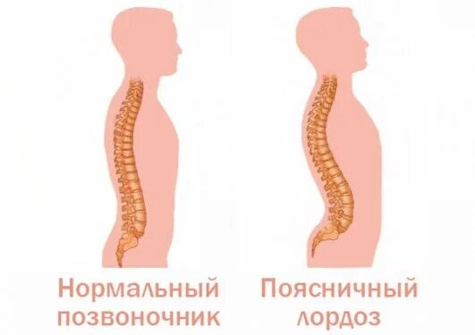 Кифоз поясничного отдела упражнения фото osteohondrosy.net uprazhneniya-pri-lordoze-poyasnichnogo-otdela-pozvonochnika.ht