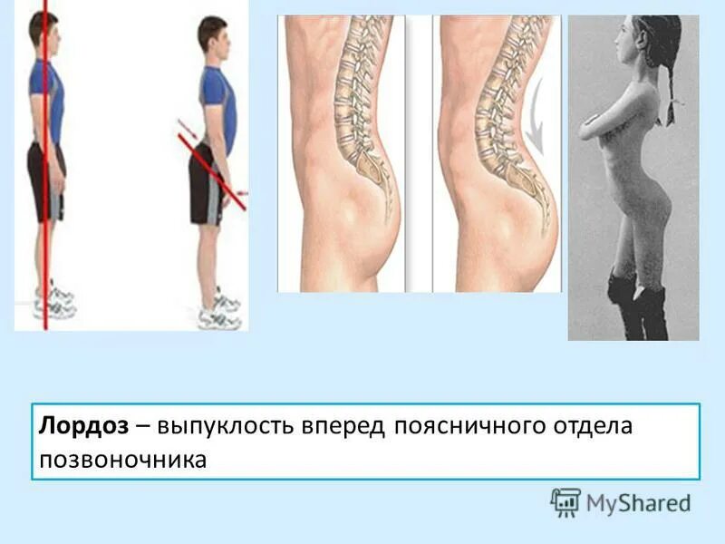 Кифоз поясничного отдела упражнения фото Кифоз позвоночника шейный
