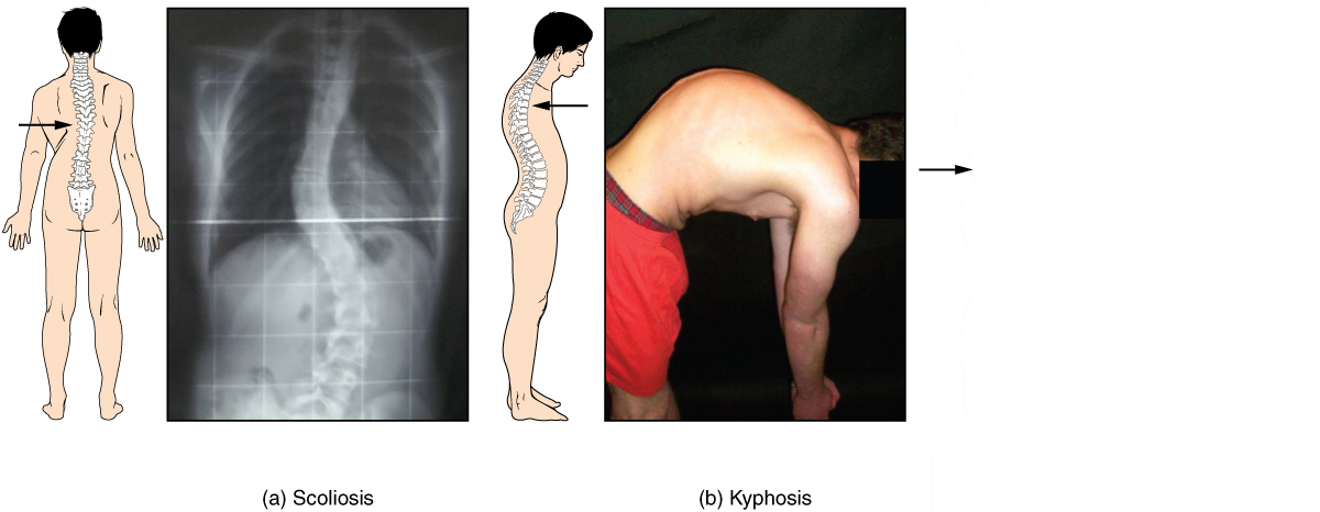Кифоз поясничного отдела упражнения фото Clinical Conditions - Advanced Anatomy 2nd. Ed.