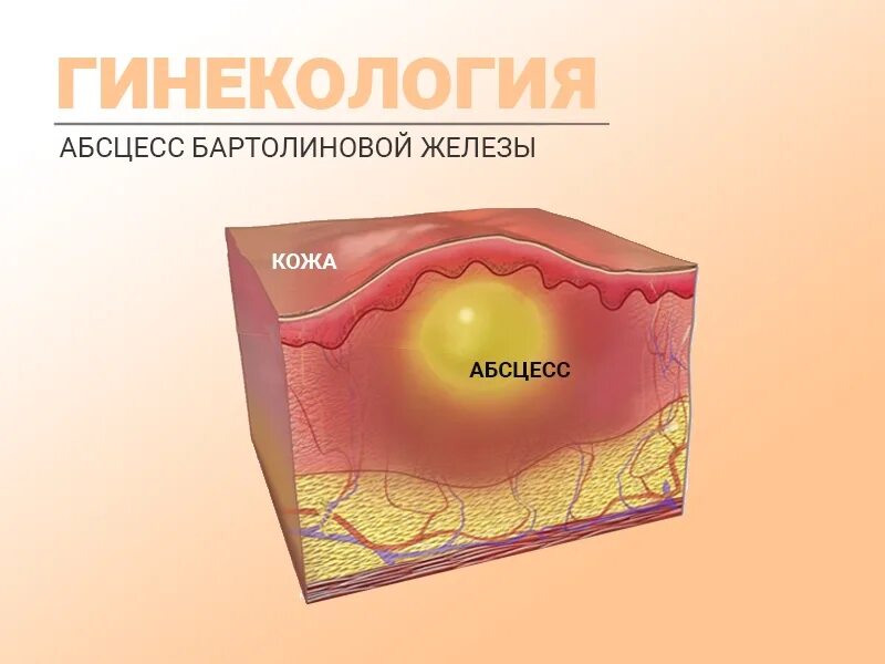 Киста бартолиновой железы фото снаружи Абсцесс бартолиновой железы. НДЦ Королев