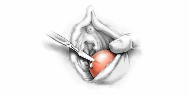 Киста бартолиновой железы фото снаружи Лечение и удаление кисты бартолиновой железы в Новосибирске установкой word-кате