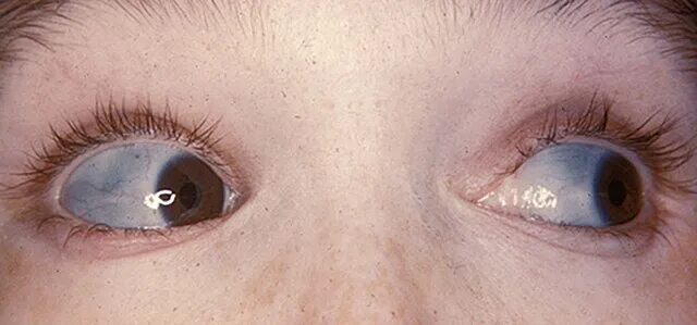 Киста глаза фото лечение File:Characteristically blue sclerae of patient with osteogenesis imperfecta.jpg