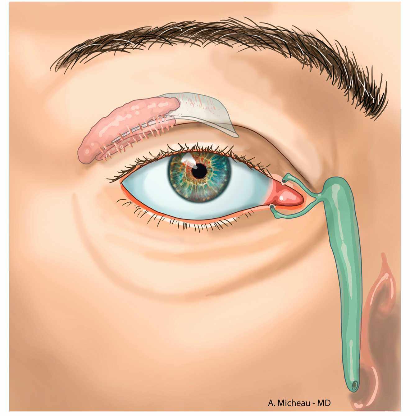 Киста глаза фото лечение Estruturas oculares acessórias - e-Anatomy - IMAIOS