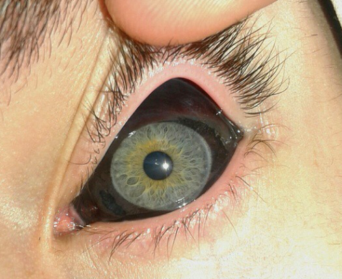 Киста глазного яблока фото Rhubarbes Eyeball tattoo, Eye photography, Eye tattoo