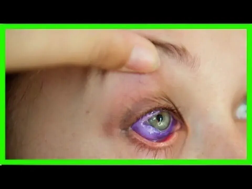 Киста глазного яблока фото A model tattooed her eyeball purple. she now could lose her eye. - YouTube