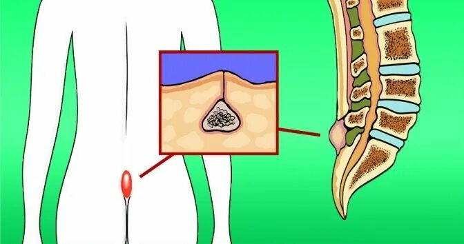 Киста копчика симптомы у женщин фото What Is Pilonidal Disease That Tends to Affect Young People, and How You Can Get