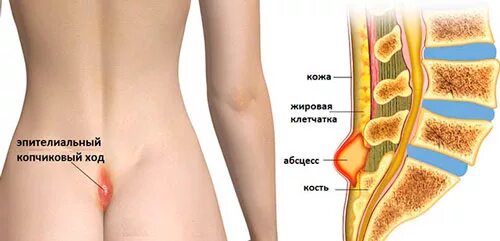 Киста копчика симптомы у женщин фото Эпителиальный копчиковый ход: причины, симптомы, диагностика, лечение