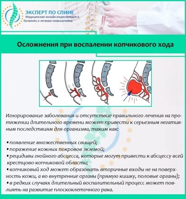 Киста копчика симптомы у женщин фото Воспаление копчикового хода: признаки, методы лечения