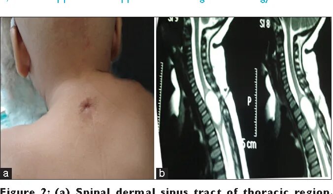 Киста копчика симптомы у женщин фото Figure 2 from Spinal dorsal dermal sinus tract: An experience of 21 cases Semant