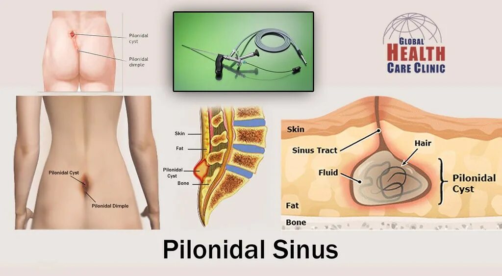 Киста копчика симптомы у женщин фото Pilonidal-Sinus-treatment-surgery-in-Chandigarh-and-Mohali. Flickr