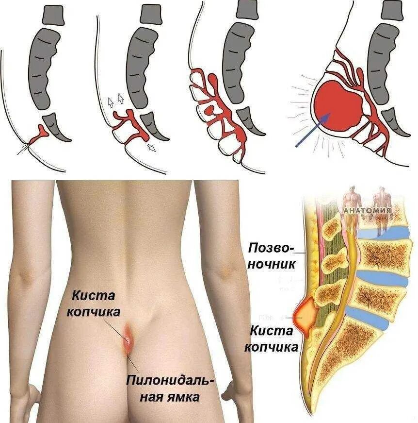 Киста копчика симптомы у женщин фото 15 января в нашем центре врач-колопроктолог Стукалова Оксана Юрьевна впервые про