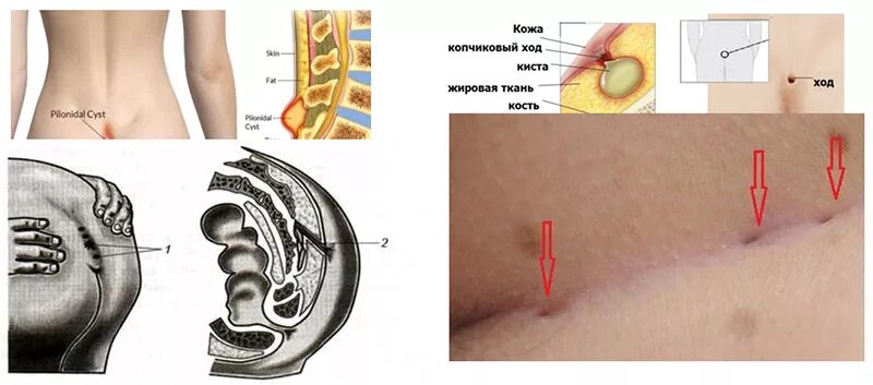 Киста копчика симптомы у женщин фото Эпителиальный копчиковый ход (ЭКХ)