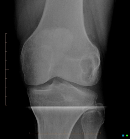 Киста кости фото Degenerative subchondral bone cyst Radiology Case Radiopaedia.org