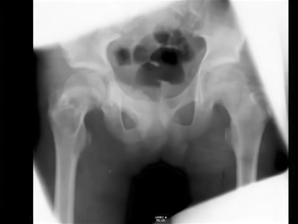 Киста кости фото Simple Bone Cyst Right Femur - YouTube