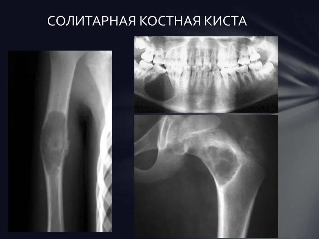 Киста кости фото Доброкачественные опухоли костей - презентация онлайн