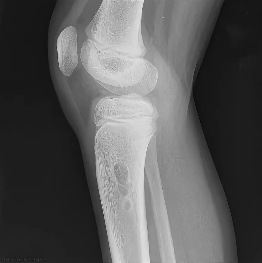 Киста кости фото Unicameral bone cyst: tibia Radiology Case Radiopaedia.org