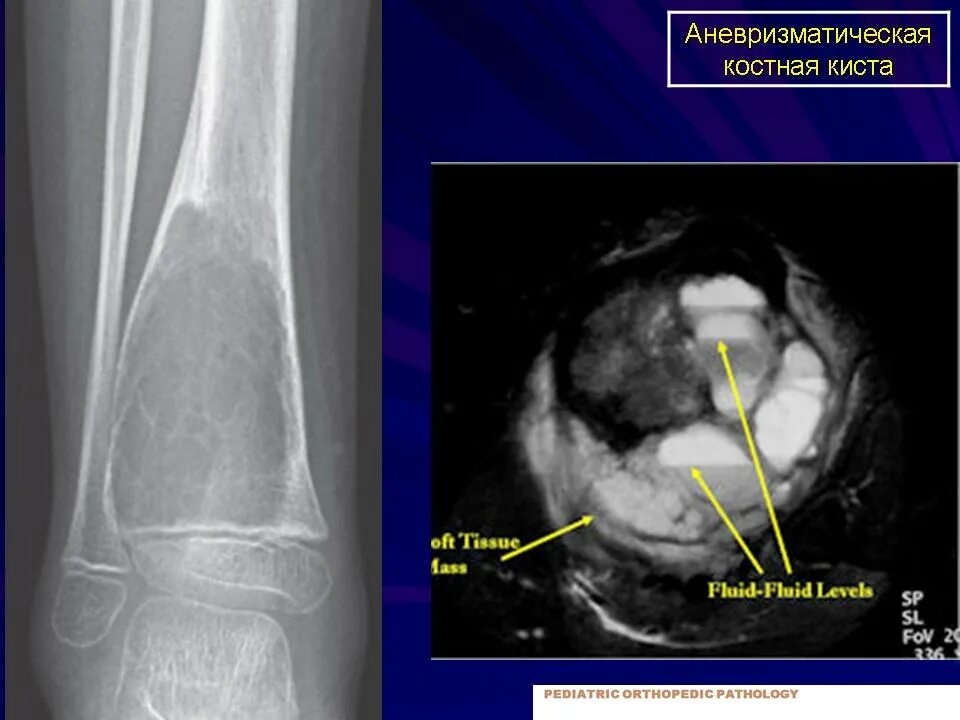 Киста кости фото КСС. Аневризматическая костная киста 2. + Портал радиологов