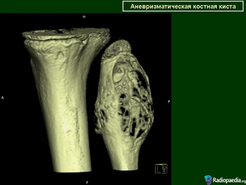 Киста кости фото КСС. Аневризматическая костная киста 2. + Портал радиологов