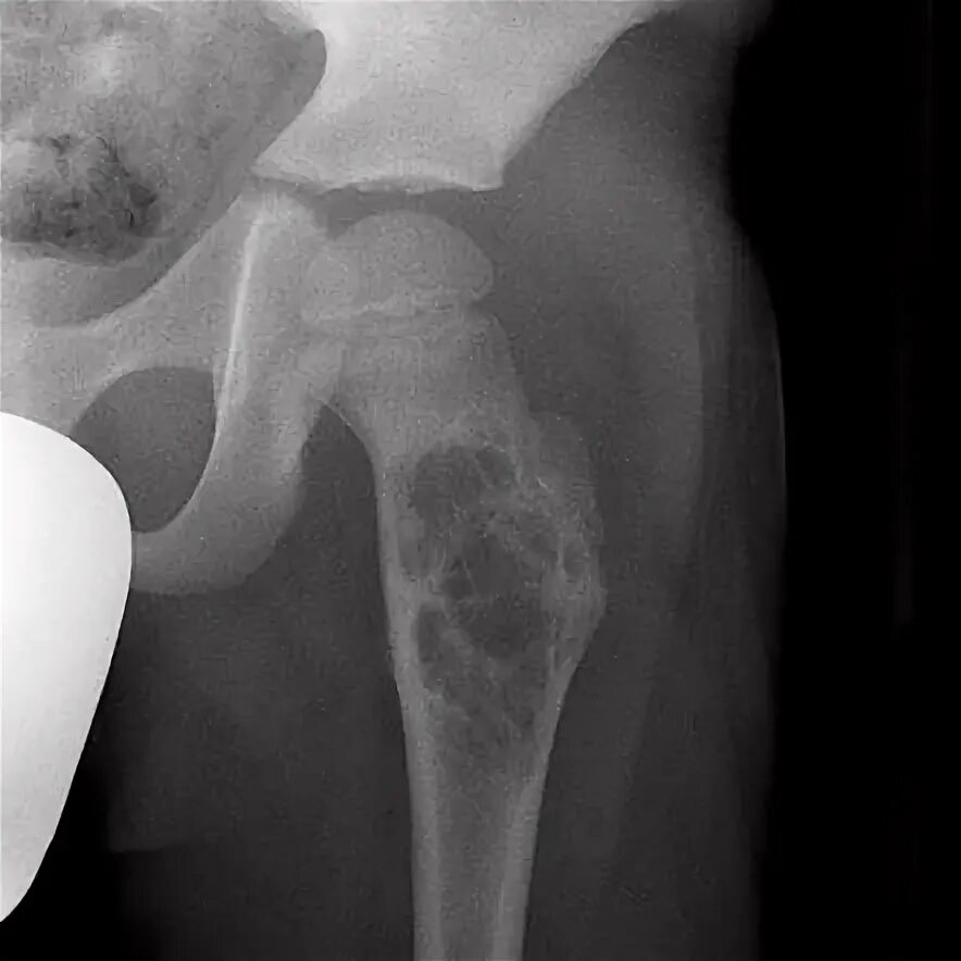 Киста кости фото Radiology Quiz 10362 Radiopaedia.org