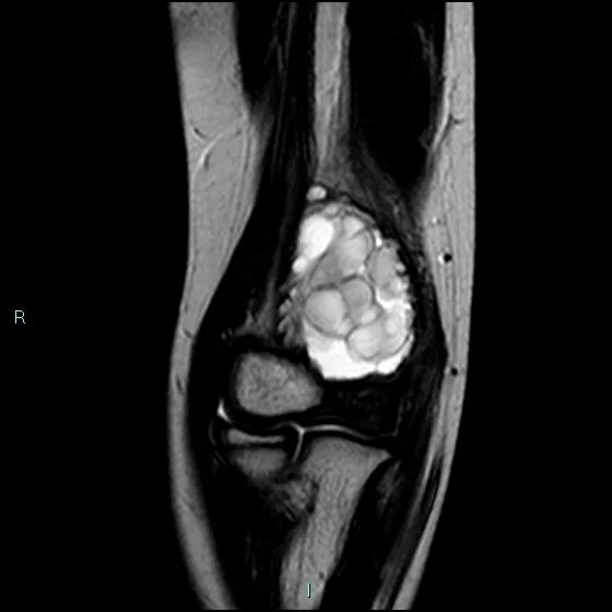 Киста кости фото Image Radiopaedia.org