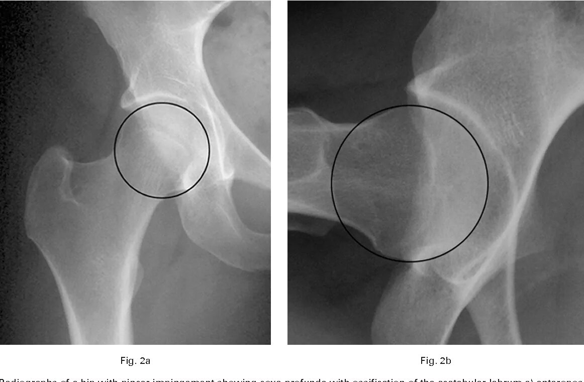 Киста кости фото Figure 2 from Hip morphology influences the pattern of damage to the acetabular 