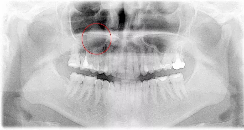 Киста мягкого неба фото dental cyst again ffs. bone around 1-6 has nicely regrown . Flickr