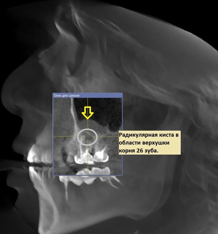 Киста на небе фото Картина хронического периодонтита Второе мнение