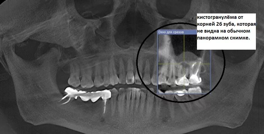 Киста на небе фото Картина хронического периодонтита Второе мнение