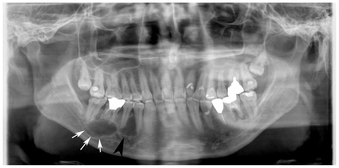 Киста на небе фото Simultaneous occurrence of keratocystic odontogenic tumor and ameloblastoma in t